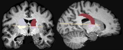 Increased Nucleus Accumbens Volume in College Binge Drinkers - Preliminary Evidence From Manually Segmented MRI Analysis